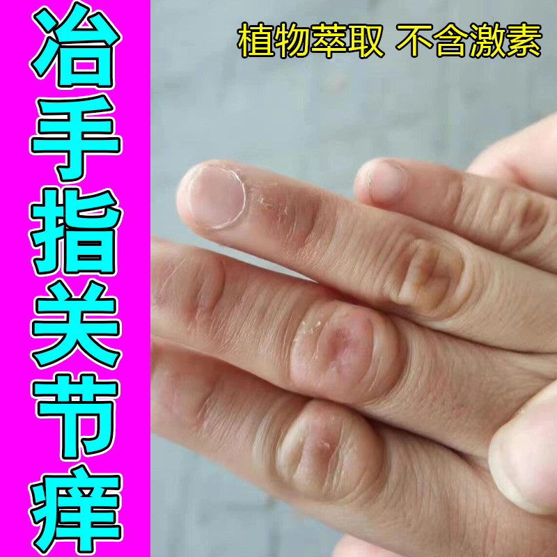 冶手指关节痒手背粗糙起硬疙瘩掉屑干燥痒红肿手感染专用修护药乳