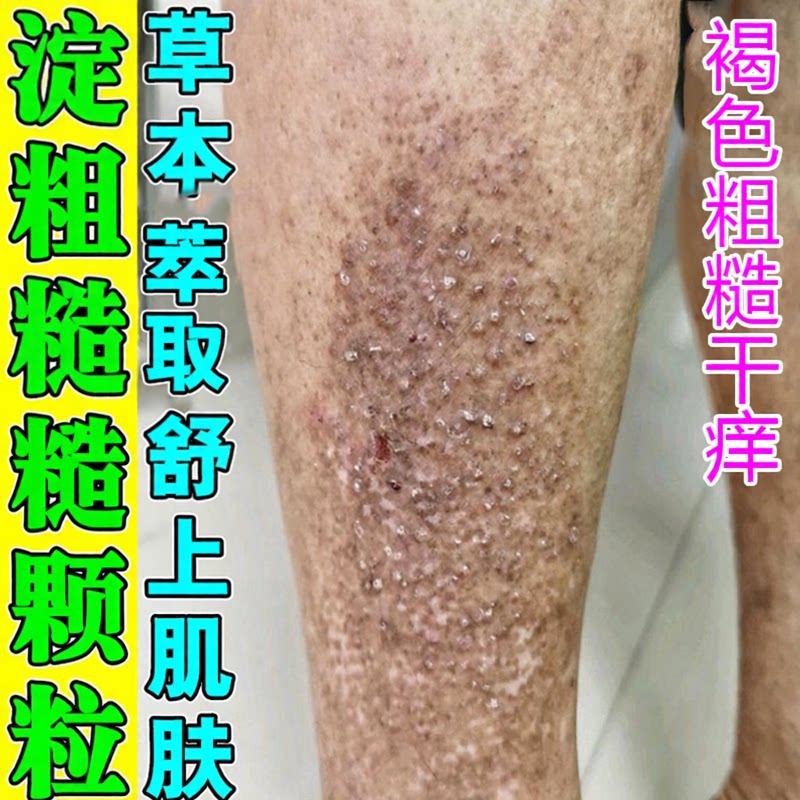 冶褐色疙瘩专用除斑状粗糙颗粒状蛋白物改善皮肤黑色素沉淀