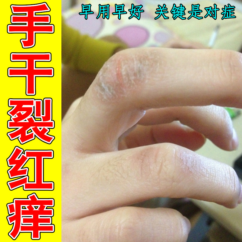 手干裂红痒手指裂口子干燥粗糙红肿过敏痒掉屑脱皮感染长硬疙瘩痒