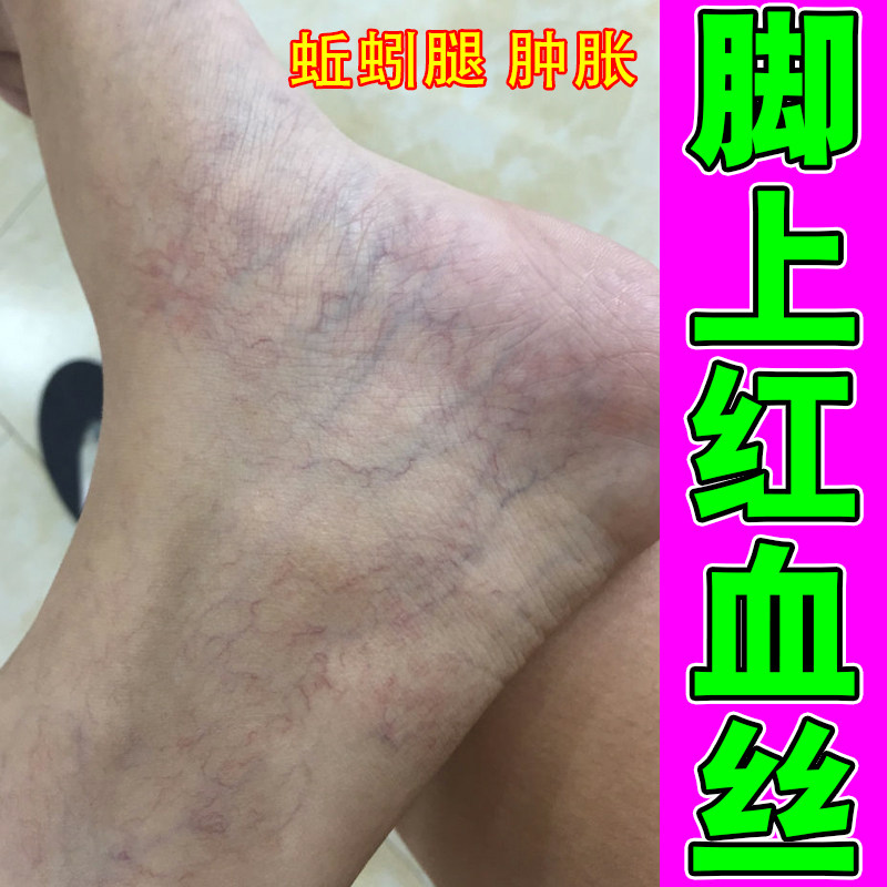 腿上青筋凸起肿胀疼痛药