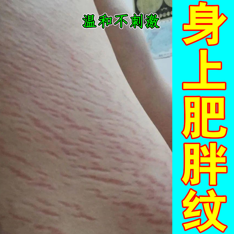 身上肥胖纹紫纹红纹青少年生长纹去妊娠纹修复淡化黑色素男女通用
