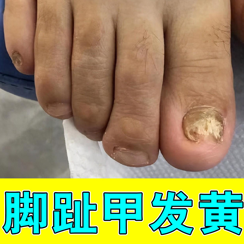 脚趾甲发黄指甲增厚残缺甲萎缩真菌性白甲空甲甲分离脱路亮甲修护