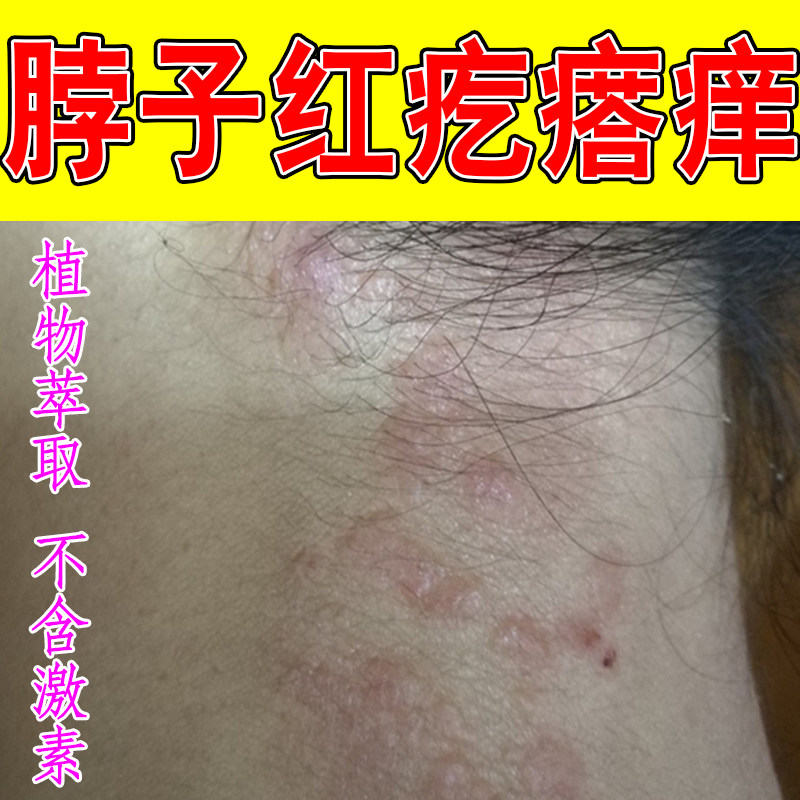 脖子红疙瘩痒脖圈神经性过敏红斑痒掉屑皮肤增厚起痘专用草本药乳