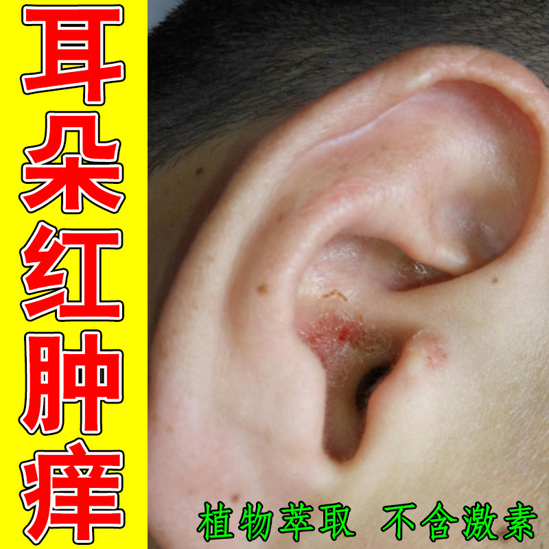 耳朵红肿痒外耳道干燥起皮掉屑脱皮流脓流水耳朵发痒过敏痒专用膏