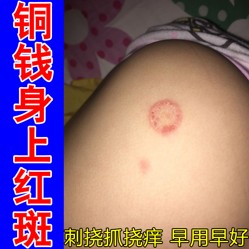 皮肤长圈状印斑皮肤表层起干屑时不时发痒脱皮四肢躯干粗糙红肿痒