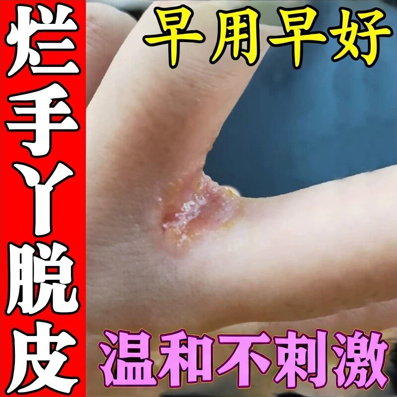手指缝痒经常碰水烂手丫糜烂痒脱皮干裂疼痛感染专用膏