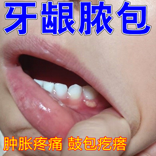 牙龈长脓包牙根尖上鼓包肿痛智齿发炎上火儿童出血干燥专用修复药