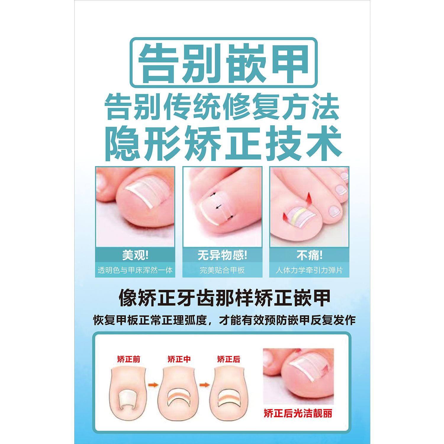 嵌甲贴片广告贴纸海报会灰指甲店背景墙甲沟炎手脚常见病图谱矫正