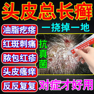 头癣药膏治头皮癣头部红斑瘙痒真菌感染结痂屑硝酸咪康唑乳膏正品