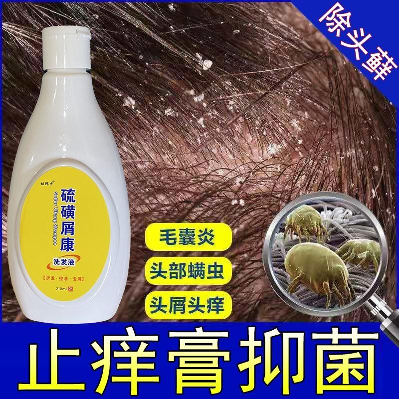 头皮专用严重头屑去屑病止痒藓