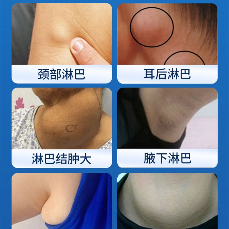 新品淋巴结消散结l节肿大除颈部脖子腋下疏通副乳儿童专用肠系膜