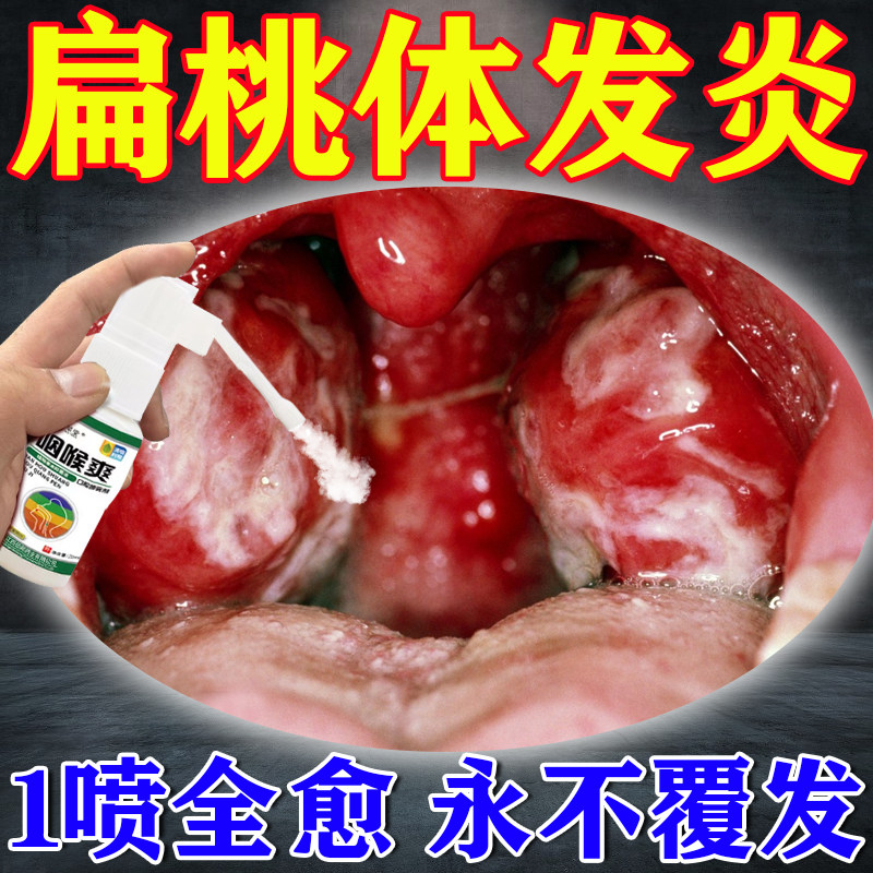 扁桃体发炎特效药儿童成人咽喉咙肿痛专用治疗扁桃体肥大肿大喷剂