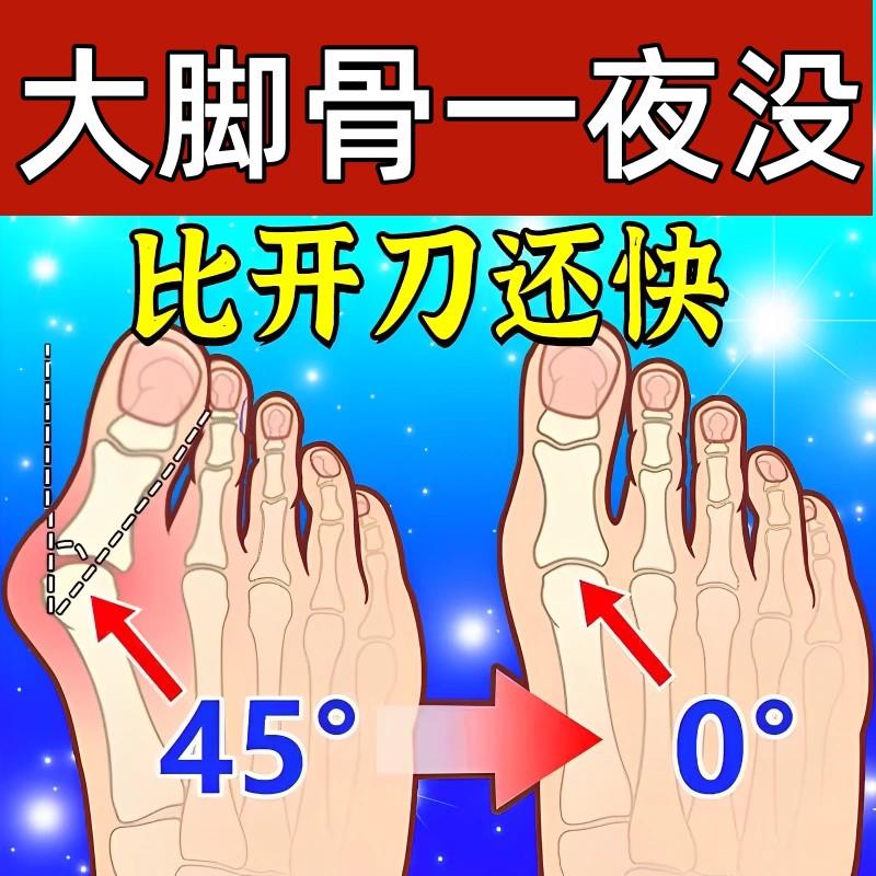 母指大拇指外翻膏贴拇外翻肌贴大脚骨脚趾矫正器脚趾变形关节疼痛