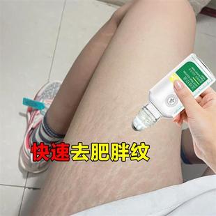 专用去除肥胖纹孕妇妊辰纹大腿生长纹腹部长纹膨胀纹痘印痘坑男女