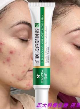 Effective Acne Removal Cream Treatment Acne Scar Spots Cream
