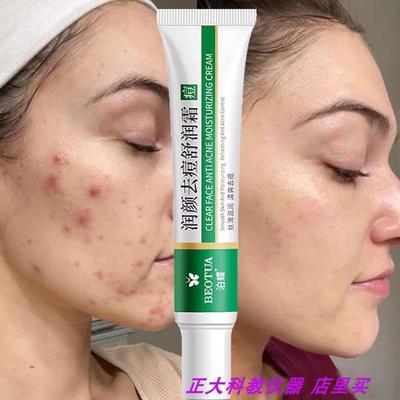 Effective Acne Removal Cream Treatment Acne Scar Spots Cream