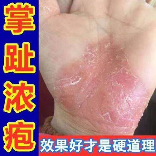 极速掌跖角化症掌跖脓包病角化病掌趾脓J疱病手脚蜕皮乾裂角皮症