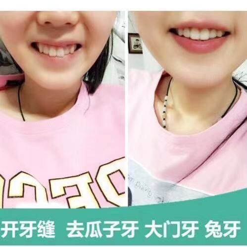 极速牙齿打磨f神器打磨机电动磨平抛光清洁牙结石牙垢烟渍虎牙磨