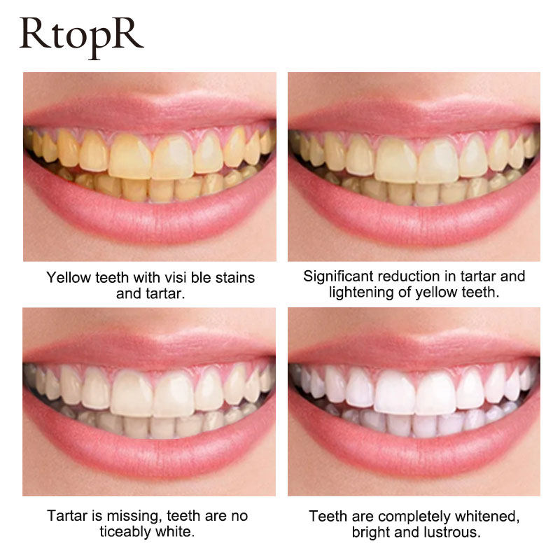 极速Teeth Cleansing Stains Oral cleaning TeethR whitening Re