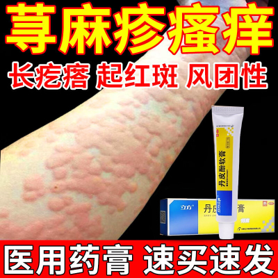 荨麻疹过敏止痒特专用效药皮肤瘙痒风团抓痕红点慢性荨麻疹中成药
