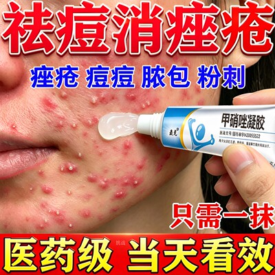 甲硝唑凝胶医用祛痘痘痤疮闭口粉刺正品脸上反复长痘红肿硬块专用