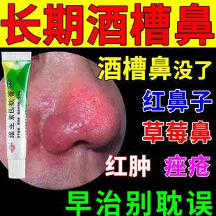 维生素b6软膏涂抹治酒糟鼻红鼻子专用药膏治疗痤疮粉刺红肿草莓鼻