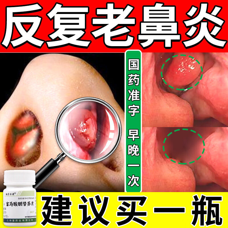 鼻炎药过敏性鼻炎鼻窦炎打喷嚏鼻塞鼻涕专特用效药富马酸酮替芬片