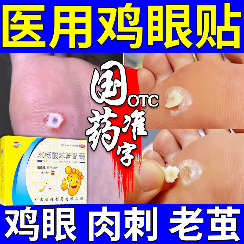 治鸡眼专用药水杨酸软膏鸡眼贴膏治肉刺药膏皮肤用药走路疼痛