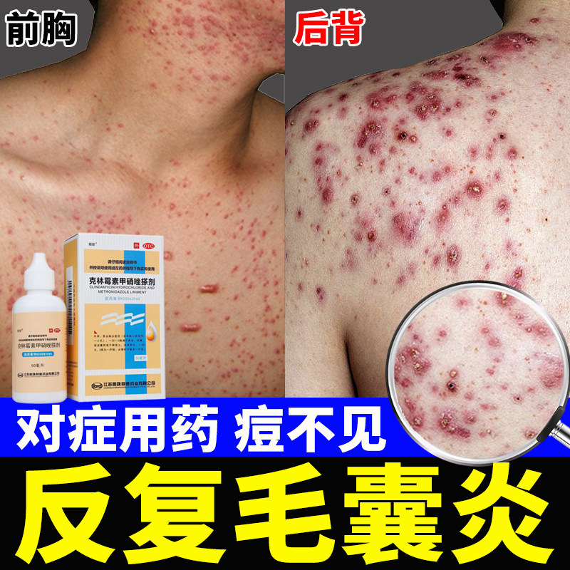 【靓能】克林霉素甲硝唑搽剂10mg8mg*50ml*1瓶/盒