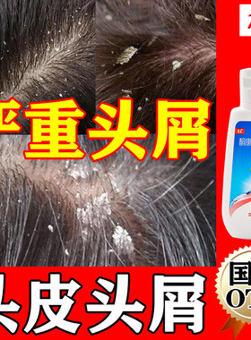 康王酮康唑洗剂头皮屑治疗药头皮痒脂溢性皮炎毛囊止痒去屑