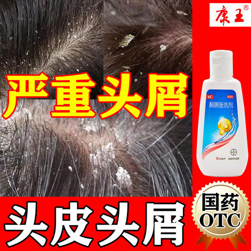 康王酮康唑洗剂头皮屑治疗药头皮痒