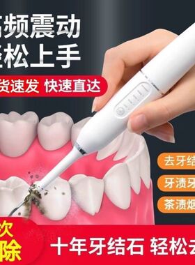 掏剔抠牙结石g神器扣牙石清理刮牙垢器清除工具去除器头专业声波