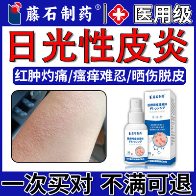 日光性皮炎紫外线过敏喷剂
