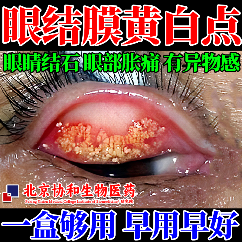 眼结膜黄白小点眼结石眼睛有异物感干涩滴眼液胀痛摩擦感lt