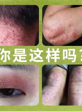 结节性脂膜炎皮下硬结红斑触碰疼痛咋混用皮肤修复膏药房同售LT21