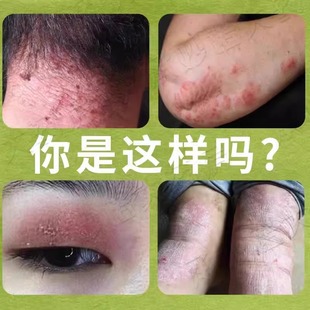 结节性脂膜炎皮下硬结红斑触碰疼痛咋混用皮肤修复膏药房同售LT21