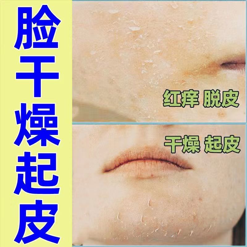 脸上长癣脸上癣面部脸痒脸上起皮干燥脸干掉皮脸部过敏脸痒瘙痒