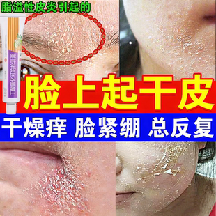 脂溢性皮炎皮肤干燥起皮皮肤过敏修复脸部红痒丁酸氢化可的松乳膏