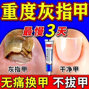 环吡酮胺乳膏官方旗舰店治灰指甲专用药亮甲面真菌感染特新效期药