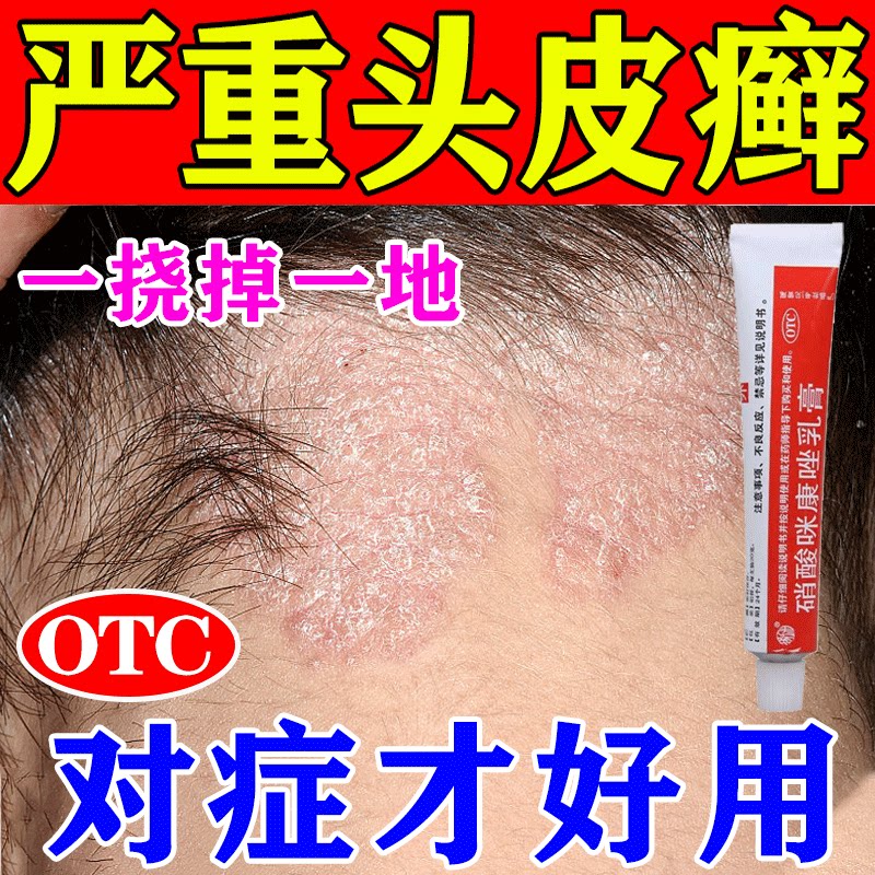 头癣药膏治头部头癣银屑癣真菌感染头皮屑癣头痒头皮红疹外用膏