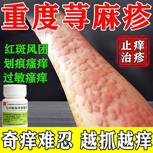 寻荨麻疹过敏止痒断专根用药治荨麻疹皮肤瘙痒药马来酸氯苯那敏片