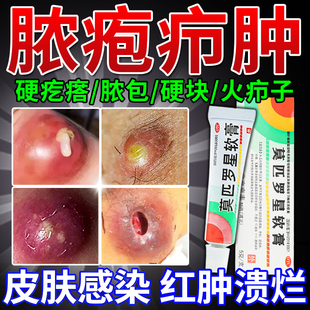 莫匹罗星软膏火疖子脓包身上红肿硬块痤疮痘痘流脓发炎毛囊炎正品