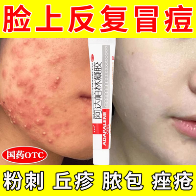 祛痘闭口粉刺痤疮膏重度暗疮阿达帕林凝胶正品改善痘印祛痘药膏