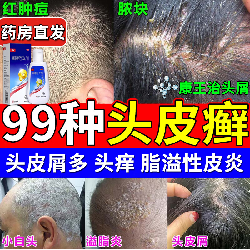 康王酮康唑洗剂治严重头屑头皮癣溢脂性皮炎头痒真菌感染止痒去屑
