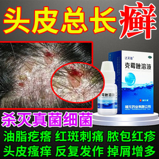 头癣银屑病专用药真菌感染结痂头皮癣头部红斑瘙痒克霉唑溶液正品