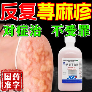 炉甘石洗剂皮肤瘙痒皮炎湿疹丘疹荨麻疹过敏止痒专用药水
