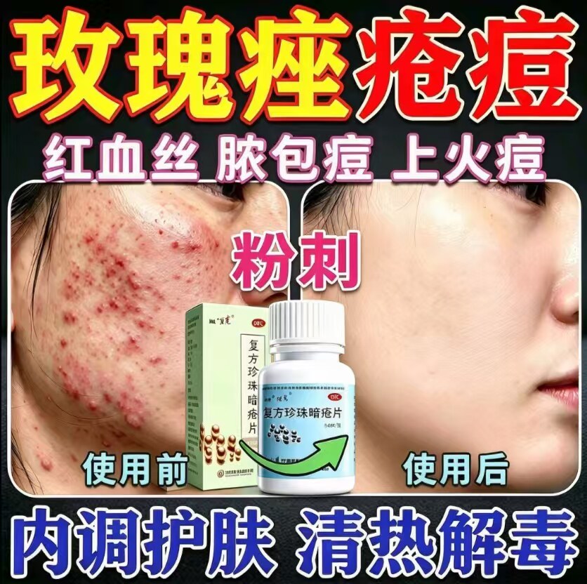 [豆克]复方珍珠暗疮片0.3g*84片*1瓶/盒