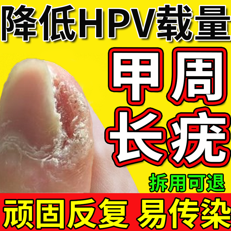 甲周疣专用膏无痛祛除儿童甲周疣手指上长疣硬皮硬疙瘩疣瘊肉粒药