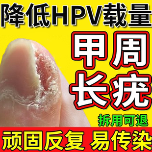 甲周疣专用膏无痛祛除儿童甲周疣手指上长疣硬皮硬疙瘩疣瘊肉粒药