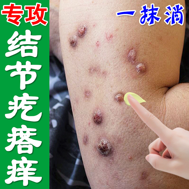 结节性痒专用治顽固硬疙瘩身上红肿结节